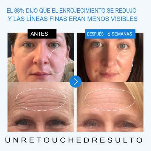 Suero de ácido hialurónico