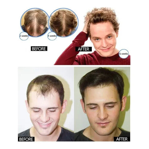 Suero para el Crecimiento del Cabello AntiCaida